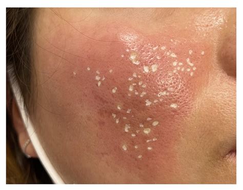 tca cross gone wrong|TCA Cross Treatment .